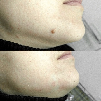 Before and after the application of Skincell For