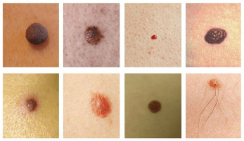 The most common spots on the skin – moles, and papilloma (warts)