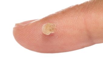 Use Skincell For in that case, if you have observed spots on the skin, birthmarks, warts, senile skin changes
