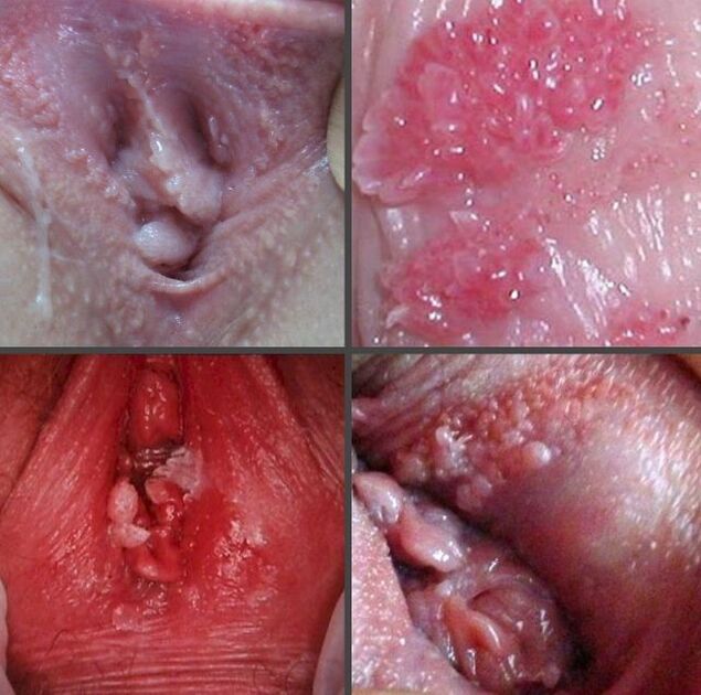 Close-up on papillomas of the vagina