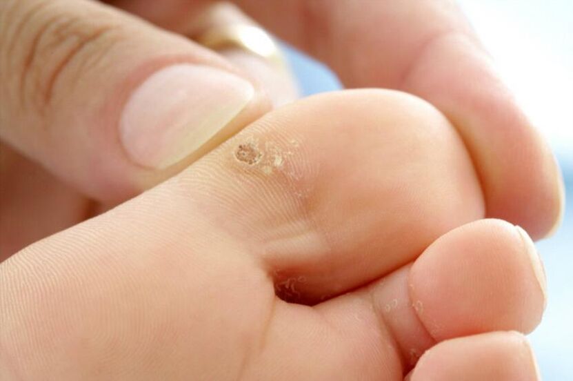 wart on the toe