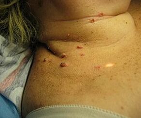 human papillomavirus on the neck