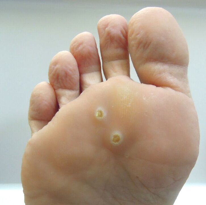 how to get rid of a wart on foot