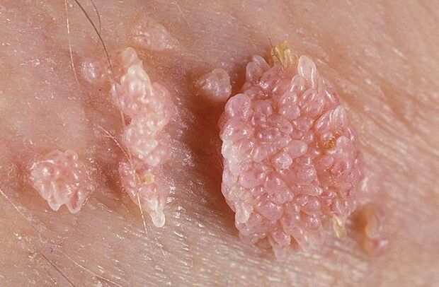 Excessive growth of genital warts