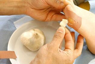 Treatment of papilloma with a compress of garlic