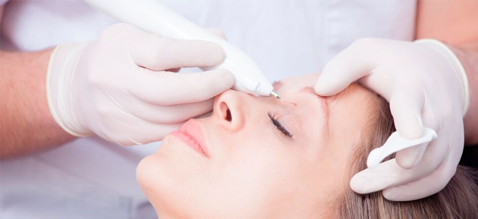 Laser Facial Warts Removal Procedure